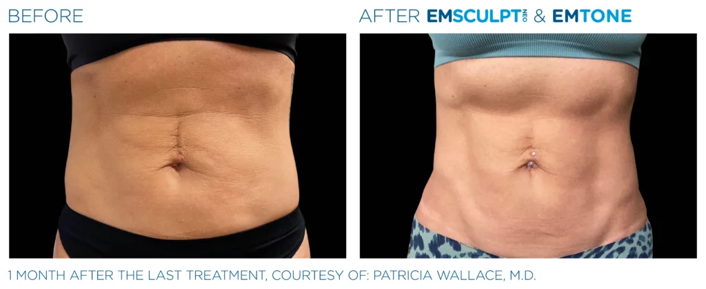 Skin tightening during weight loss