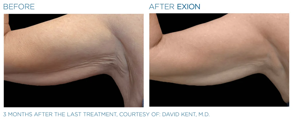 Body contouring treatments in DeLand Florida.